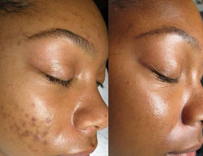 Hand Made Kojic Acid Dark Spot Remover Soap